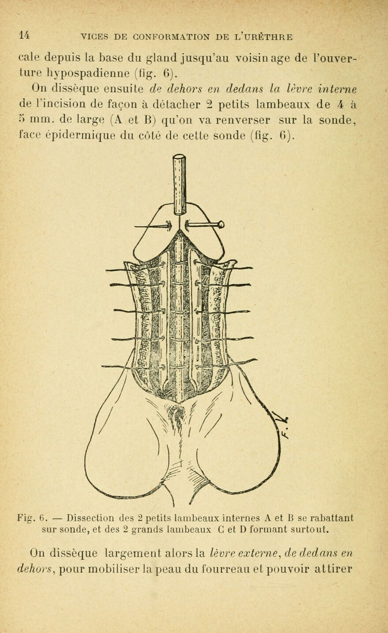 cale depuis la base du gland jusqu'au voisinage de l'ouver- ture hypospadienne (fig. 6). On dissèque ensuite de dehors en dedans la lèvre interne de l'incision de façon à détacher 2 petits lambeaux de 4 à 5 mm. de large (A et B) qu'on va renverser sur la sonde, face épidermique du coté de cette sonde (fig. 6). Fii 6. — Dissection des 2 petits lambeaux internes A et B se rabattant sur sonde, et des 2 grands lambeaux C et D formant surtout. On dissèque largement alors la lèvre externe, de dedans en dehors, pour mobiliser la peau du fourreau et pouvoir attirer