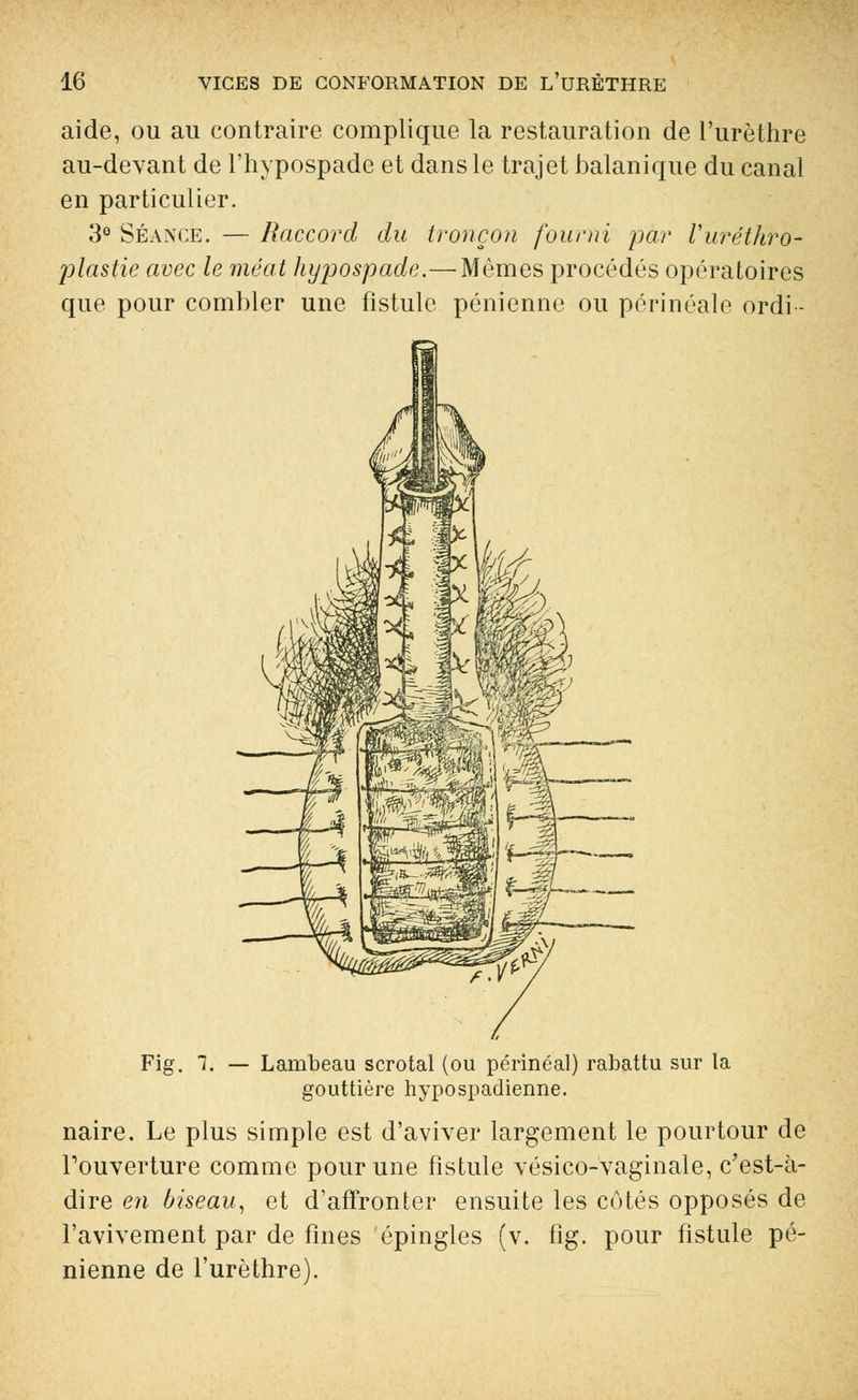 aide, ou au contraire complique la restauration de l'urèthre au-devant de l'hypospade et dans le trajet balanique du canal en particulier. 3° Séance. — Raccord du tronçon fourni par Vuréthro- plastie avec le méat hyjjospade.—Mêmes procédés opératoires que pour combler une fistule pénienne ou périnéale ordi - Fig. 7. — Lambeau scrotal (ou périnéal) rabattu sur la gouttière hypospadienne. naire. Le plus simple est d'aviver largement le pourtour de l'ouverture comme pour une fistule vésico-vaginale, c'est-à- dire en biseau, et d'affronter ensuite les cotés opposés de l'avivement par de fines épingles (v. fig. pour fistule pé- nienne de l'urèthre).