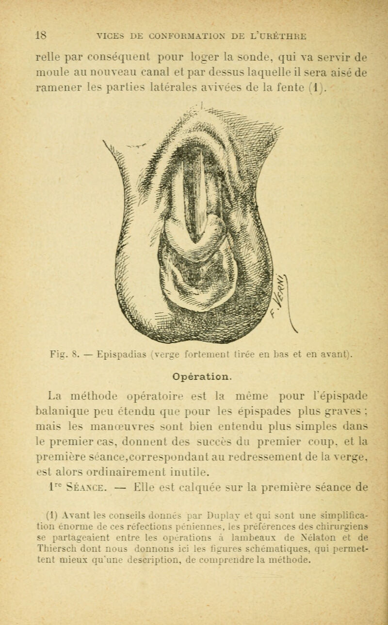 relie par conséquent pour loger la sonde, qui va servir de moule au aouveau canal et par dessus laquelle il sera ;: - ramener les parties latérales avivées de la fente J . _ B. — Epispadias verge fortement tirée en bas et en avant . Opération. La méthode opératoire e:-t la même pour L'épis balanique peu étendu que pour les epi>pades plu- _ mais les manœuvres sont bien entendu plus simples dans le premier cas, donnent des -ueeès du premier coup, et la premier- - - ndant au redressement de la verg . est alors ordinairement inutile. 1 Séance. — Elle est calquée sur la première séanee de (1) Avant les conseils v et qui sont une simplifica- tion énorme de ces rciec :s préférences des chirurgiens se partageaient entre les opérations à lambeaux de Nélaton et de rsch dont nous donnons ici les figures schématiques, qui ; tent mieux qu'une description, de comprendre la méthode.