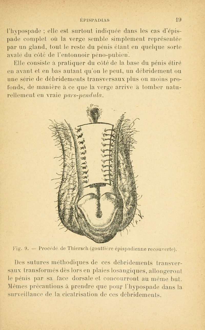 l'hypospade ; elle est surtout indiquée dans les cas d'épis- pade complet où la verge semble simplement représentée par un gland, tout le reste du pénis étant en quelque sorte avalé du coté de l'entonnoir péno-pubien'. Elle consiste à pratiquer du côté de la base du pénis étiré en avant et en bas autant qu'on le peut, un débridement ou une série de débridements transversaux plus ou moins pro- fonds, de manière à ce que la verge arrive à tomber natu- rellement en vraie pars-pendula. Fig. 9. — Procédé de Thiersch (gouttière épispadienne recouverte). Des sutures méthodiques de ces débridements transv er saux transformés dès lors en plaies losangiques, allongeront le pénis par sa face dorsale et concourront au même but. Mêmes précautions à prendre que pour l'hypospade dans la surveillance de la cicatrisation de ces débridements.