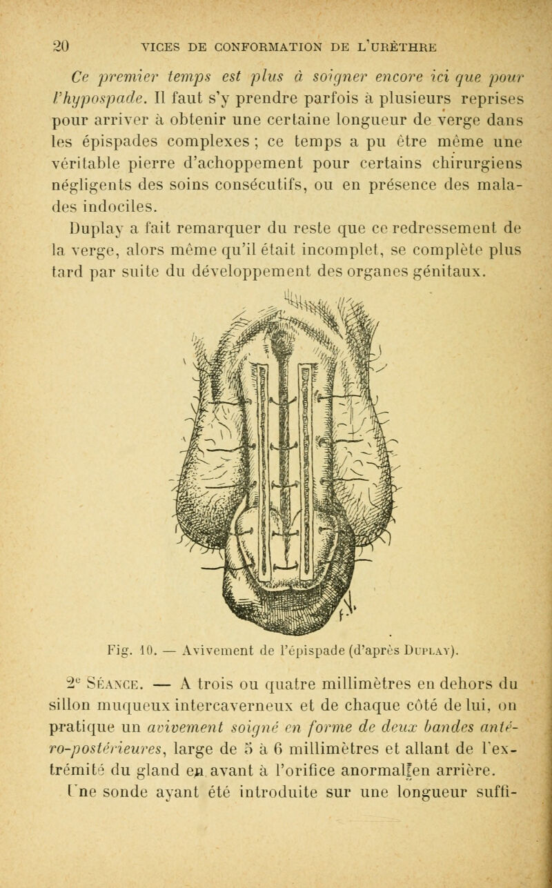 Ce premier temps est plus à soigner encore ici que pour ïhypospade. Il faut s'y prendre parfois à plusieurs reprises pour arriver à obtenir une certaine longueur de verge dans les épispades complexes ; ce temps a pu être même une véritable pierre d'achoppement pour certains chirurgiens négligents des soins consécutifs, ou en présence des mala- des indociles. Duplay a fait remarquer du reste que ce redressement de la verge, alors même qu'il était incomplet, se complète plus tard par suite du développement des organes génitaux. ^ ^ Fig. 10. — Avivement de l'épispade (d'aprùs Dlpi.ay). 2e Séance. — A trois ou quatre millimètres en dehors du sillon muqueux intercaverneux et de chaque côté de lui, on pratique un avivement soigne en forme de deux bandes anté- ro-postérieures, large de o à 6 millimètres et allant de l'ex- trémité du gland en avant à l'orifice anormalîen arrière. [ne sonde ayant été introduite sur une longueur suffi-