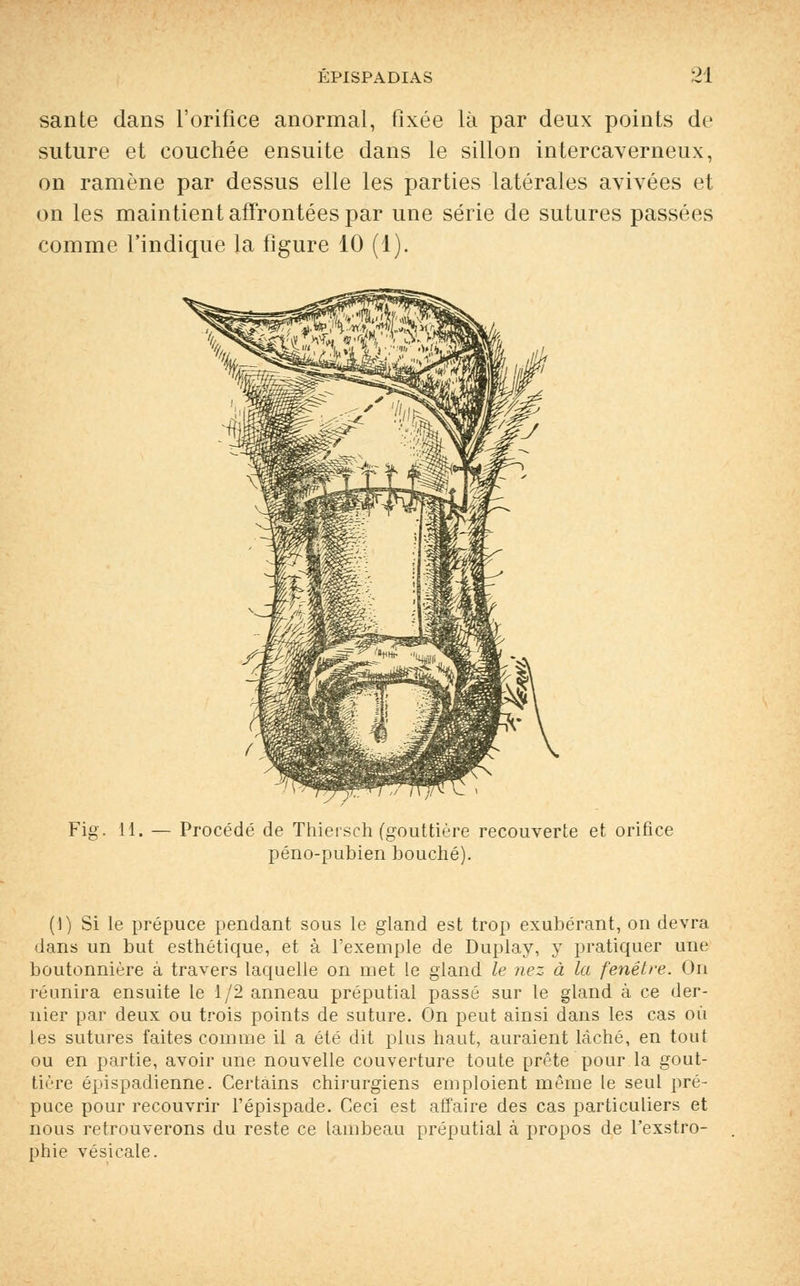 santé dans l'orifice anormal, fixée là par deux points de suture et couchée ensuite dans le sillon intercaverneux, on ramène par dessus elle les parties latérales avivées et on les maintient affrontées par une série de sutures passées comme l'indique la figure 10 (1). Fig. 11. — Procédé de Thiersch (gouttière recouverte et orifice péno-pubien bouché). (■)) Si le prépuce pendant sous le gland est trop exubérant, on devra dans un but esthétique, et à l'exemple de Duplay, y pratiquer une boutonnière à travers laquelle on met le gland le nez à la fenêtre. On réunira ensuite le 1/2 anneau préputial passé sur le gland à ce der- nier par deux ou trois points de suture. On peut ainsi dans les cas où les sutures faites comme il a été dit plus haut, auraient lâché, en tout ou en partie, avoir une nouvelle couverture toute prête pour la gout- tière épispadienne. Certains chirurgiens emploient même le seul pré- puce pour recouvrir l'épispade. Ceci est affaire des cas particuliers et nous retrouverons du reste ce lambeau préputial à propos de l'exstro- phie vésicale.