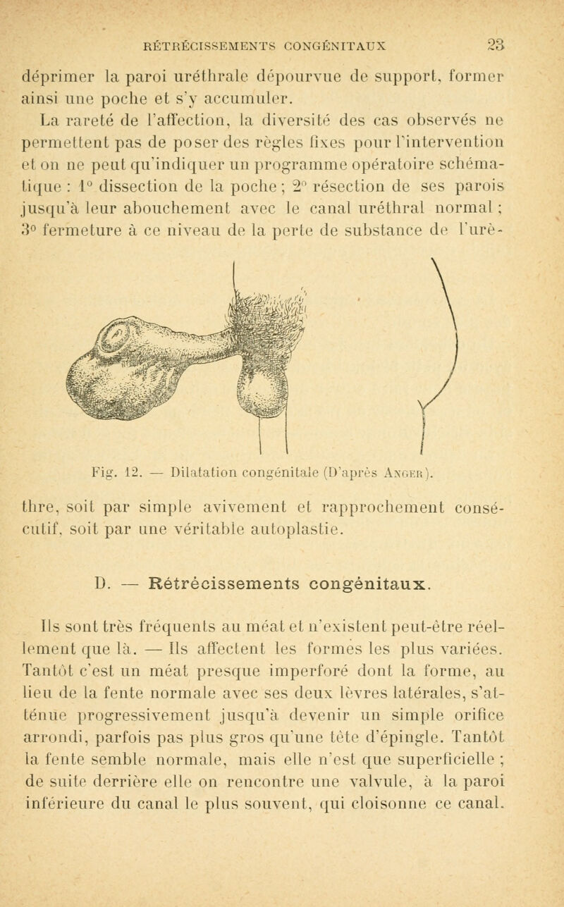 déprimer la paroi uréthrale dépourvue de support, former ainsi une poche et s'y accumuler. La rareté de l'affection, la diversité des cas observés ne permettent pas de poser des règles fixes pour l'intervention et on ne peut qu'indiquer un programme opératoire schéma- tique : 1° dissection de la poche ; 2n résection de ses parois jusqu'à leur abouchement avec le canal uréthral normal ; 3° fermeture à ce niveau de la perte de substance de l'urè- Fig. 12. — Dilatation congénitale (D'après Anger). thre, soit par simple avivement et rapprochement consé- cutif, soit par une véritable autoplastie. 1). Rétrécissements congénitaux. Ils sont très fréquents au méat et n'existent peut-être réel- lement que là. — Ils affectent les formes les plus variées. Tantôt c'est un méat presque imperforé dont la forme, au lieu de la fente normale avec ses deux lèvres latérales, s'at- ténue progressivement jusqu'à devenir un simple orifice arrondi, parfois pas plus gros qu'une tète d'épingle. Tantôt la fente semble normale, mais elle n'est que superficielle ; de suite derrière elle on rencontre une valvule, à la paroi inférieure du canal le plus souvent, qui cloisonne ce canal.