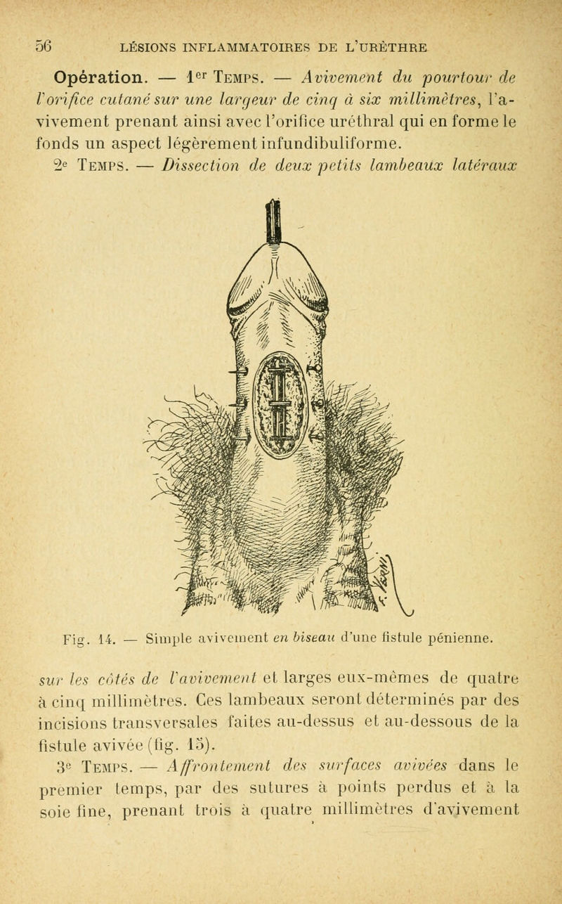 Opération. — 1er Temps. — Avivement du pourtour de Vorifice cutané sur une largeur de cinq à six millimètres, l'a- vivement prenant ainsi avec l'orifice uréthral qui en forme le fonds un aspect légèrement infundibuliforme. 2e Temps. — Dissection de deux petits lambeaux latéraux Fig. 14. — Simple avivement en biseau d'une fistule pénienne. sur les côtés de Vavivement et larges eux-mêmes de quatre à cinq millimètres. Ces lambeaux seront déterminés par des incisions transversales faites au-dessus et au-dessous de la fistule avivée (fig. 15). 3e Temps. — Affrontement des surfaces avivées dans le premier temps, par des sutures à points perdus et à la soie fine, prenant trois à quatre millimètres davivement