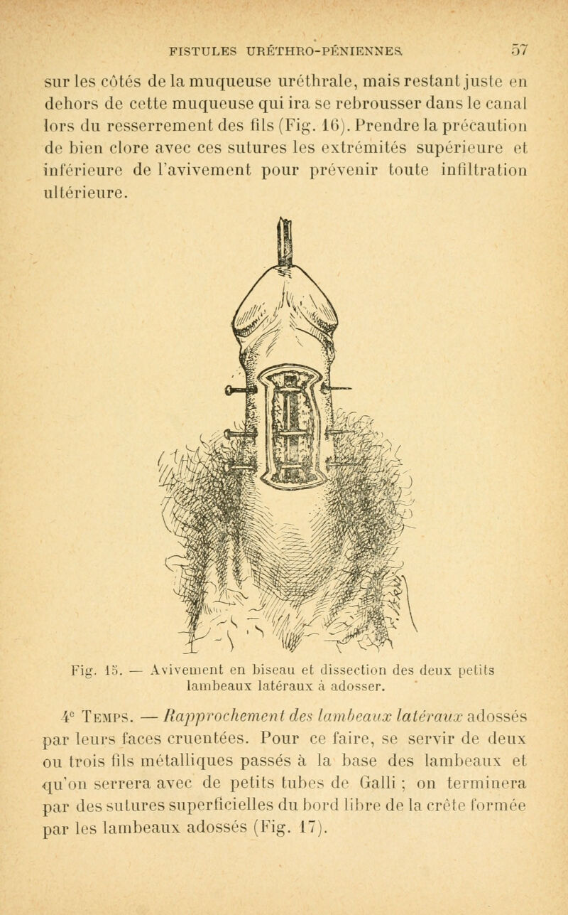 sur les côtés de la muqueuse uréthrale, mais restant juste en dehors de cette muqueuse qui ira se rebrousser dans le canal lors du resserrement des fils (Fig. 16). Prendre la précaution de bien clore avec ces sutures les extrémités supérieure et inférieure de l'avivement pour prévenir toute infiltration ultérieure. Fier. 15. Avivenient en biseau et dissection des deux petits lambeaux latéraux à adosser. ic Temps. — Rapprochement des lambeaux latéraux adossés par leurs faces cruentées. Pour ce faire, se servir de deux ou trois fils métalliques passés à la base des lambeaux et qu'on serrera avec de petits tubes de Galli ; on terminera par des sutures superficielles du bord libre de la crête formée par les lambeaux adossés (Fig. 17).