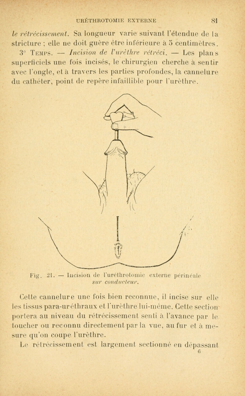 le rétrécissement. Sa longueur varie suivant l'étendue de la stricture ; elle ne doit guère être inférieure à 5 centimètres. 3° Temps. — Incision de Vurèthre rétréci. — Les plans superficiels une fois incisés, le chirurgien cherche à sentir avec l'ongle, et à travers les parties profondes, la cannelure du cathéter, point de repère infaillible pour l'urèthre. Fii 21. — Incision de ruréthrotomie externe périncale sur conducteur. Cette cannelure une fois bien reconnue, il incise sur elle les tissus para-uréthraux et l'urèthre lui-même. Cette section portera au niveau du rétrécissement senti à l'avance par le toucher ou reconnu directement par la vue, au fur et à me- sure qu'on coupe l'urèthre. Le rétrécissement est largement sectionné en dépassant