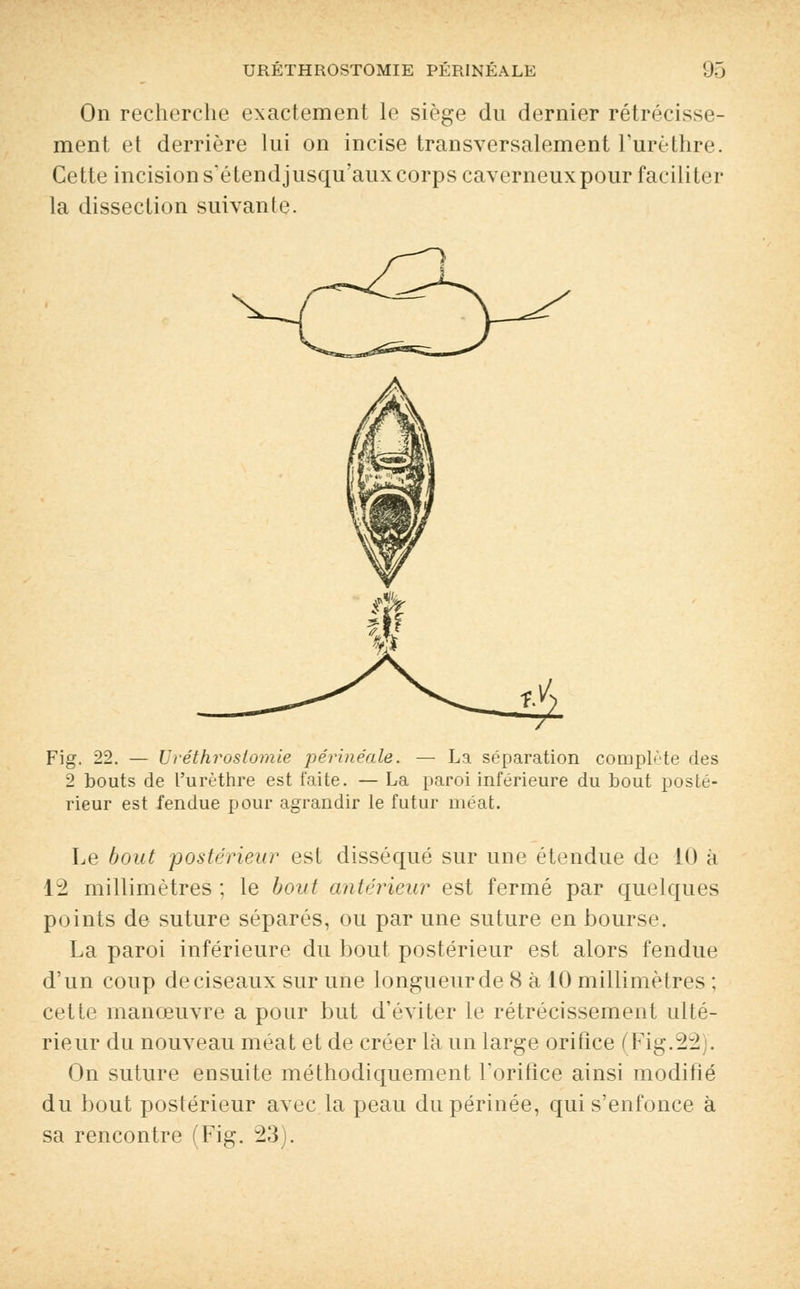On recherche exactement le siège du dernier rétrécisse- ment et derrière lui on incise transversalement Furèthre. Cette incision s'étendjusqu'aux corps caverneuxpour faciliter la dissection suivante. Fig. 22. — Uréthrostomie périnéale. — La séparation complète des 2 bouts de l'urèthre est faite. — La paroi inférieure du bout posté- rieur est fendue pour agrandir le futur méat. Le bout postérieur est disséqué sur une étendue de 10 à 12 millimètres ; le bout antérieur est fermé par quelques points de suture séparés, ou par une suture en bourse. La paroi inférieure du bout postérieur est alors fendue d'un coup de ciseaux sur une longueur de 8 à 10 millimètres ; cette manœuvre a pour but d'éviter le rétrécissement ulté- rieur du nouveau méat et de créer là un large orifice ( Fig.22 . On suture ensuite méthodiquement l'orifice ainsi modifié du bout postérieur avec la peau du périnée, qui s'enfonce à sa rencontre (Fig. 23).