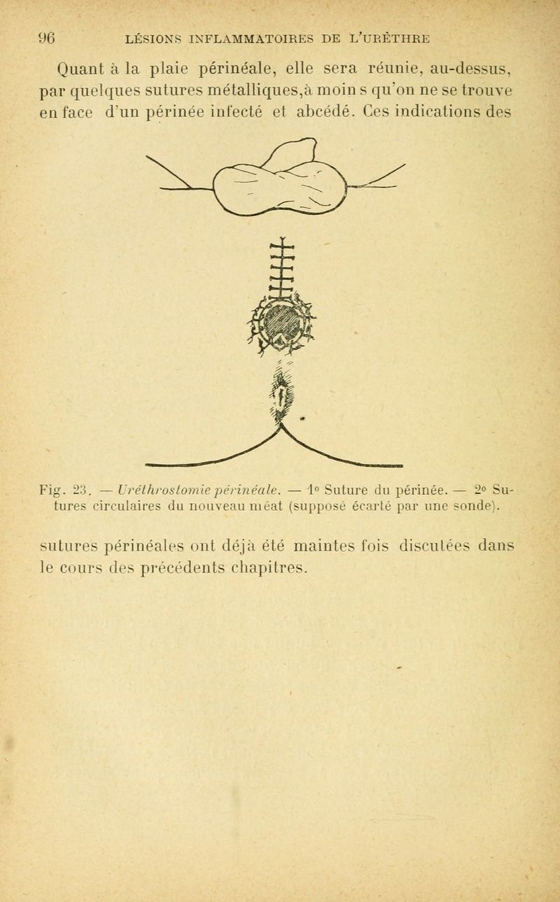 Quant à la plaie périnéale, elle sera réunie, au-dessus. par quelques sutures métalliques,à moin s qu'on ne se trouve en face d'un périnée infecté et abcédé. Ces indications des Fig. 23. — Uréthrostomiepérinéale. — 1° Suture du périnée. — 2» Su- tures circulaires du nouveau méat (supposé écarté par une sonde). sutures périnéales ont déjà été maintes fois disculées dans le cours des précédents chapitres.