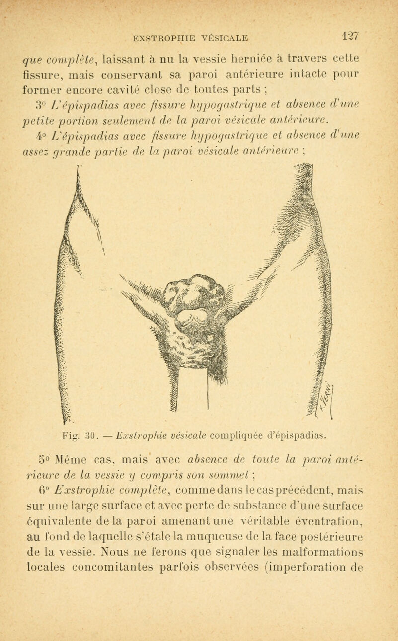 que complète, laissant à nu la vessie herniée à travers cette fissure, mais conservant sa paroi antérieure intacte pour former encore cavité close de toutes parts ; 3° L épispadias avec fissure hypogastrique et absence d'une petite portion seulement de la paroi vésicule antérieure. 4° L'épispadias avec fissure hypogastmque et absence d'une assez grande partie de la paroi vésicule antérieure ; Fig. 30. — Exstrophie vésicule compliquée d'épispadias. 5° Même cas, mais avec absence de toute la paroi anté- rieure de la vessie y compris son sommet ; 6° Exstrophie complète, comme dans le cas précédent, mais sur une large surface et avec perte de substance d'une surface équivalente delà paroi amenant une véritable éventration, au fond de laquelle s'étale la muqueuse de la face postérieure de la vessie. Nous ne ferons que signaler les malformations locales concomitantes parfois observées (imperforation de