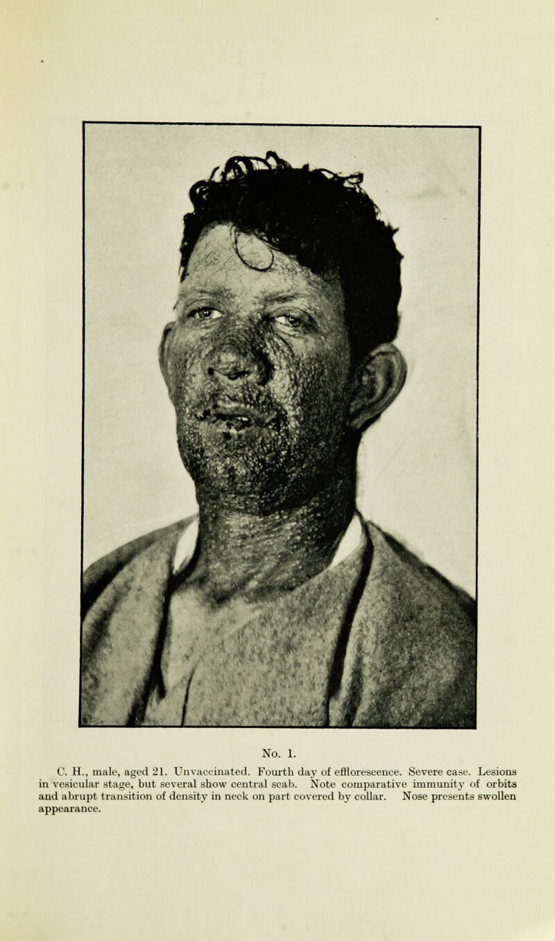 C. H., male, aged 21. Unvaccinated. Fourth day of efflorescence. Severe case. Lesions in vesicular stage, but several show central scab. Note comparative immunity of orbits and abrupt transition of density in neck on part covered by collar. Nose presents swollen appearance.