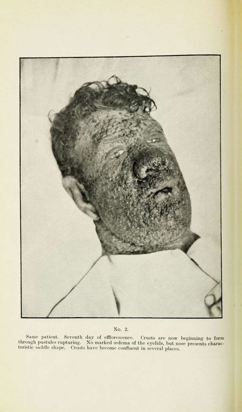 Same patient. Seventh day of efflorescence. Crusts are now beginning to form through pustules rupturing. No marked cedema of the eyelids, but nose presents charac- teristic saddle shape. Crusts have become confluent in several places.