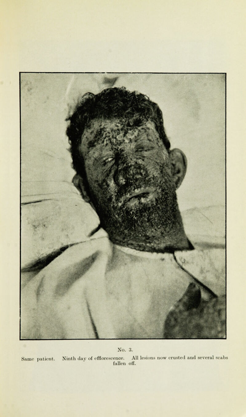 Same patient. Ninth day of efflorescence. All lesions now crusted and several scabs fallen off.
