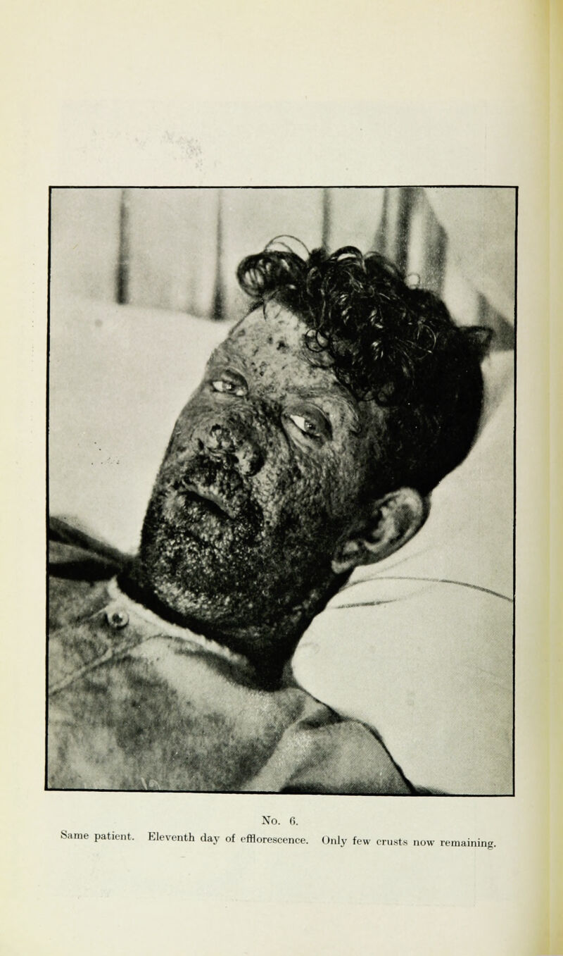 Same patient, Eleventh day of efflorescence. Only few crusts now remaining.