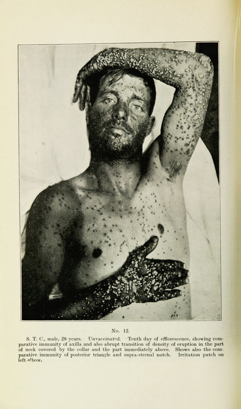 S. T. C, male, 28 years. Unvaccinated. Tenth day of efflorescence, showing com- parative immunity of axilla and also abrupt transition of density of eruption in the part of neck covered by the collar and the part immediately above. Shows also the com- parative immunity of posterior triangle and supra-sternal notch. Irritation patch on left o'bow.