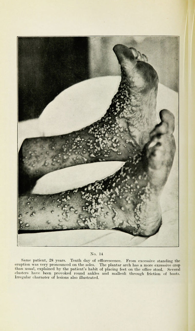 Same patient, 28 years. Tenth day of efflorescence. From excessive standing the eruption was very pronounced on the soles. The plantar arch has a more excessive'crop than usual, explained by the patient's habit of placing feet on the office stool. Several clusters have heen provoked round ankles and malleoli through friction of boots. Irregular character of lesions also illustrated.