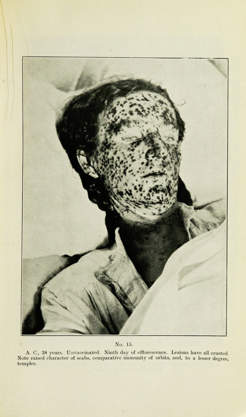 A. C, 38 years. Unvaccinated. Ninth day of efflorescence. Lesions have all crusted Note raised character of scabs, comparative immunity of orbits, and, to a lesser degree, temples.