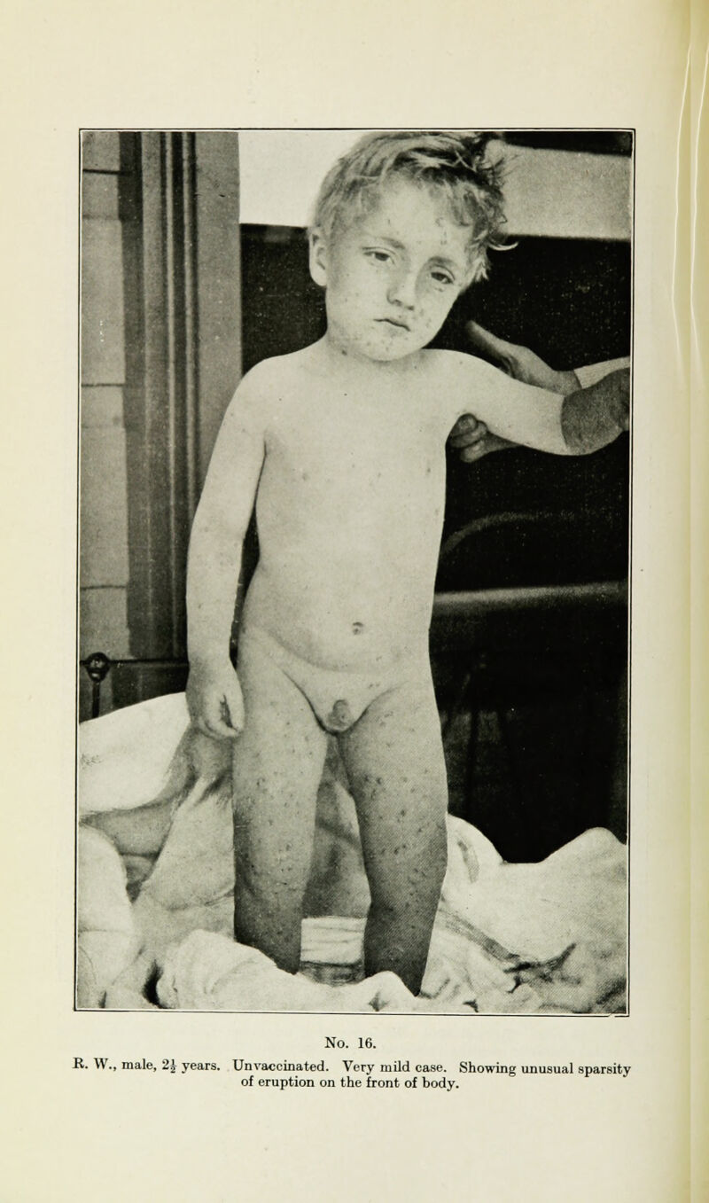 B. W., male, 2J years. Unvaccinated. Very mild case. Showing unusual sparsity of eruption on the front of body.