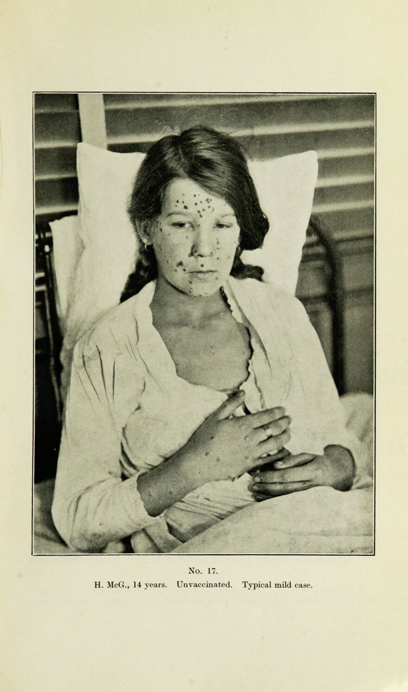 H. McG., 14 years. Unvaccinated. Typical mild case.