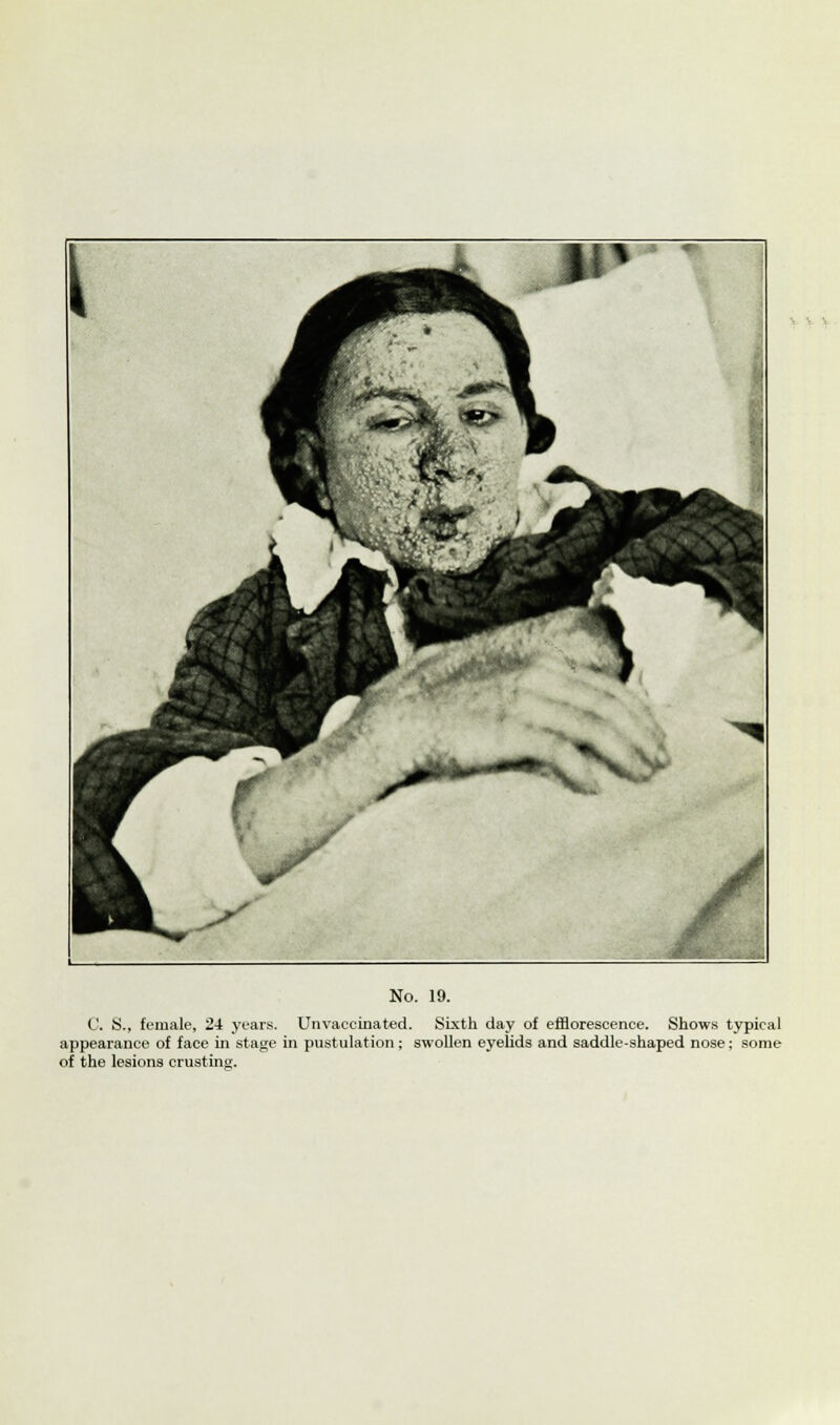 I No. 19. C. S., female, 24 years. Unvaccinated. Sixth day of efflorescence. Shows typical appearance of face in stage in pustulation ; swollen eyelids and saddle-shaped nose; some of the lesions crusting.
