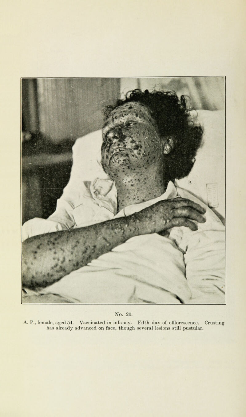 A. P.. female, aged 54. Vaccinated in infancy. Fifth day of efflorescence. Crusting has already advanced on face, though several lesions still pustular.