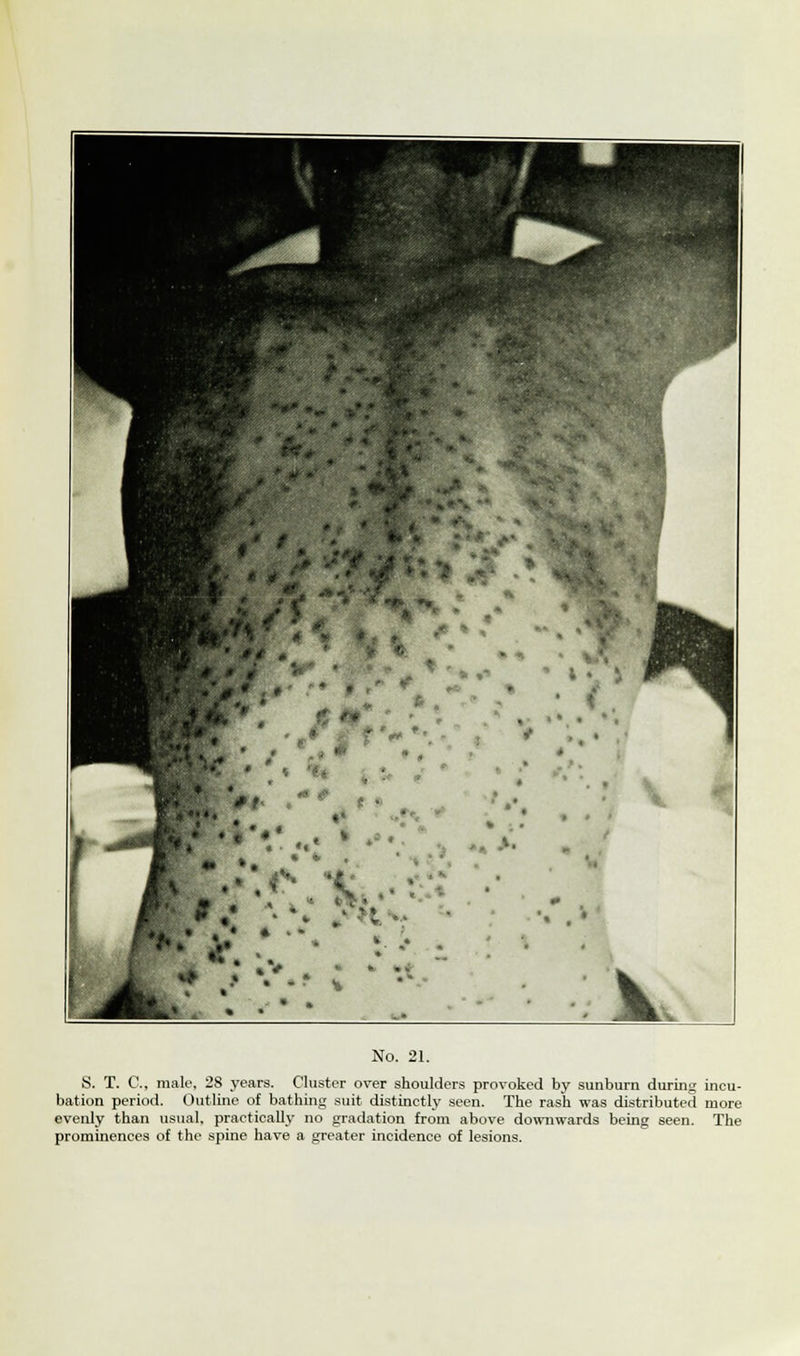 V No. 21. S. T. C, male, 28 years. Cluster over shoulders provoked by sunburn during incu- bation period. Outline of bathing suit distinctly seen. The rash was distributed more evenly than usual, practically no gradation from above downwards being seen. The prominences of the spine have a greater incidence of lesions.
