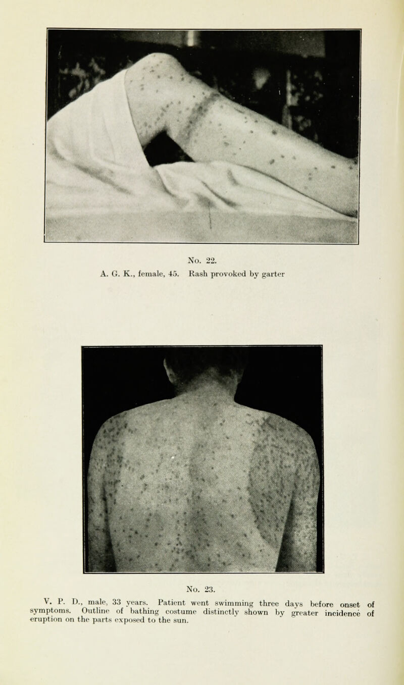 A. G. K., female, 45. Rash provoked by garter No. 23. V. P. D., male, 33 years. Patient went swimming three days before onset of symptoms. Outline of bathing costume distinctly shown by greater incidence of eruption on the parts exposed to the sun.