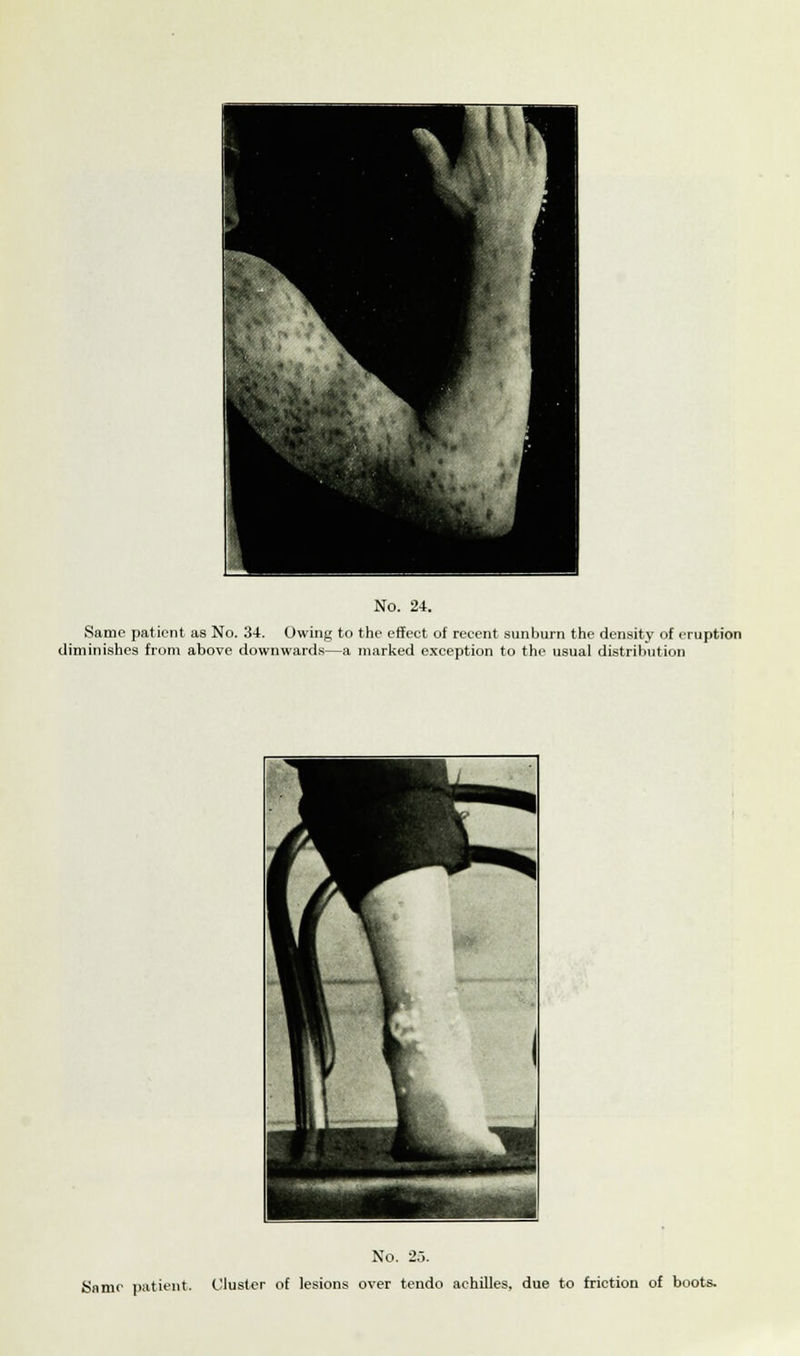 Same patient as No. 34. Owing to the effect of recent sunburn the density of eruption diminishes from above downwards—a marked exception to the usual distribution No. 2.5. Same patient. Cluster of lesions over tendo achilles, due to friction of boots.