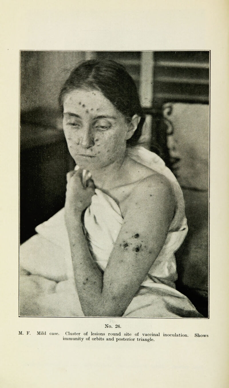 M. F. Mild case. Cluster of lesions round site of vaccinal inoculation. Shows immunity of orbits and posterior triangle.