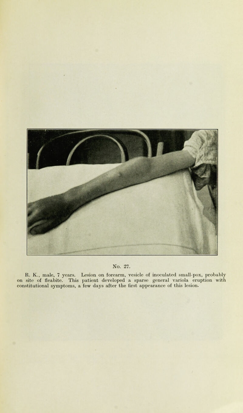 R. K., male, 7 years. Lesion on forearm, vesicle of inoculated small-pox, probably on site of rleabite. This patient developed a sparse general variola eruption with constitutional symptoms, a few days after the first appearance of this lesion.