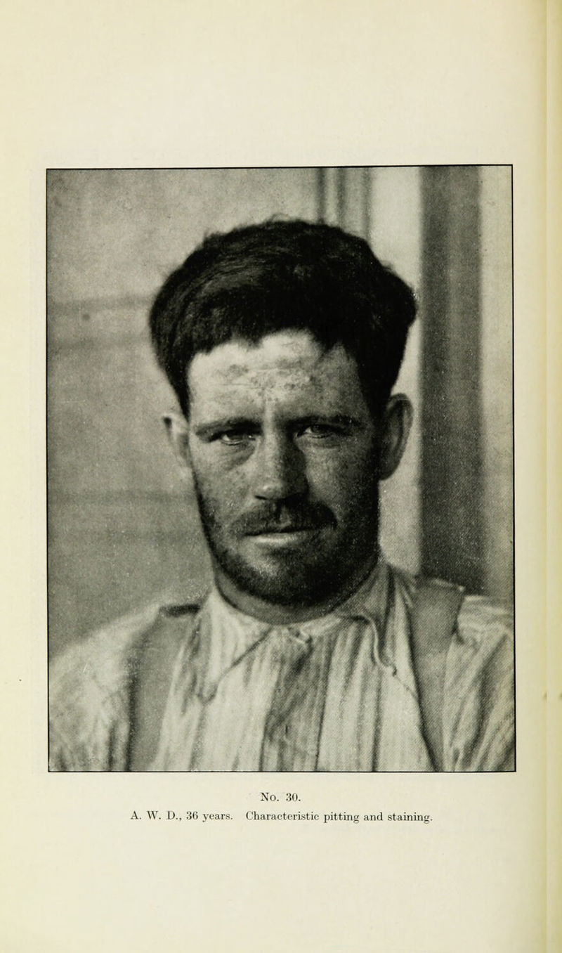 A. W. D., 36 years. Characteristic pitting and staining.