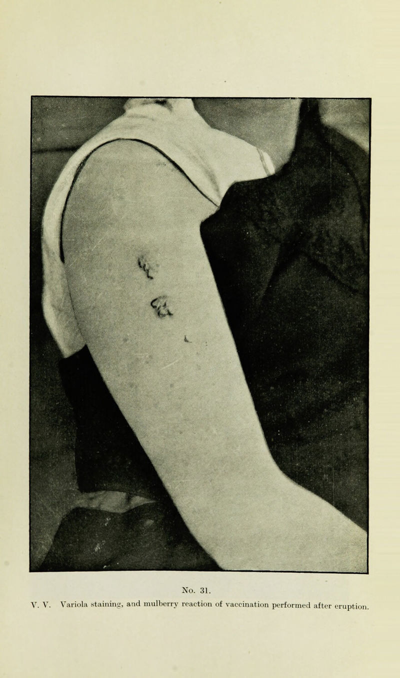 V. V. Variola staining, and mulberry reaction of vaccination performed after eruption.