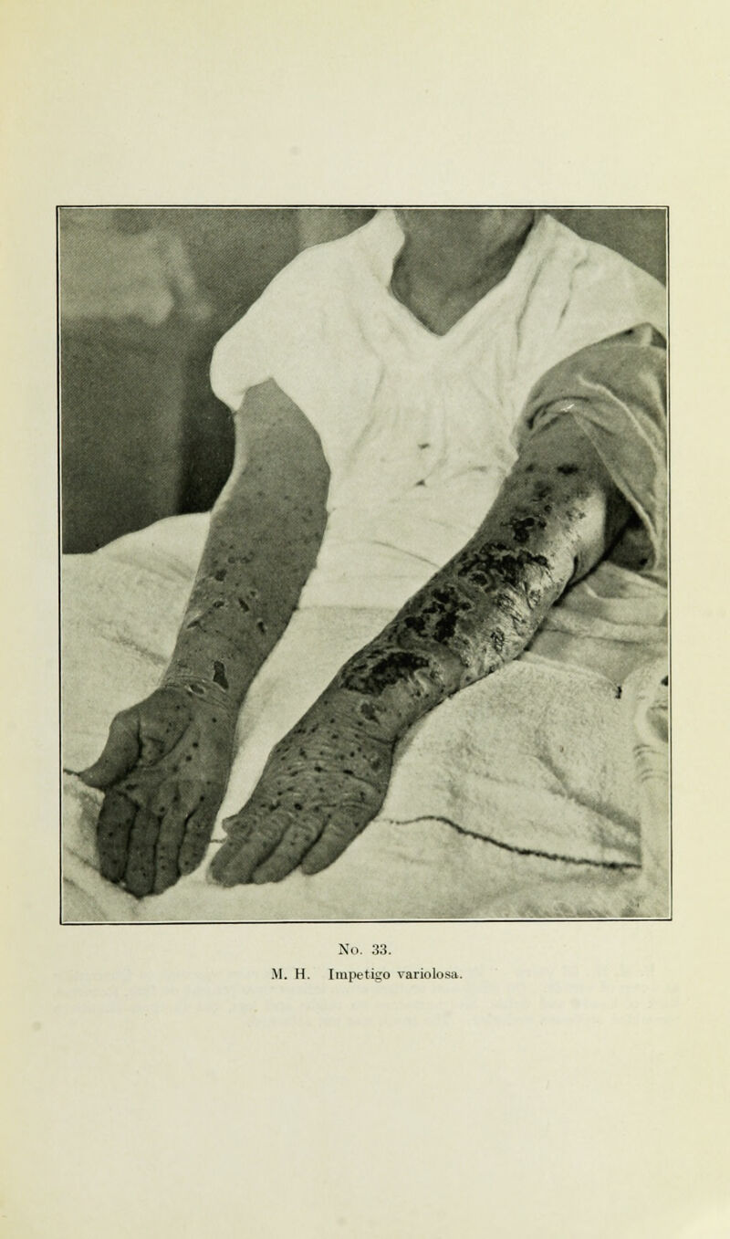 M. H. Impetigo variolosa.