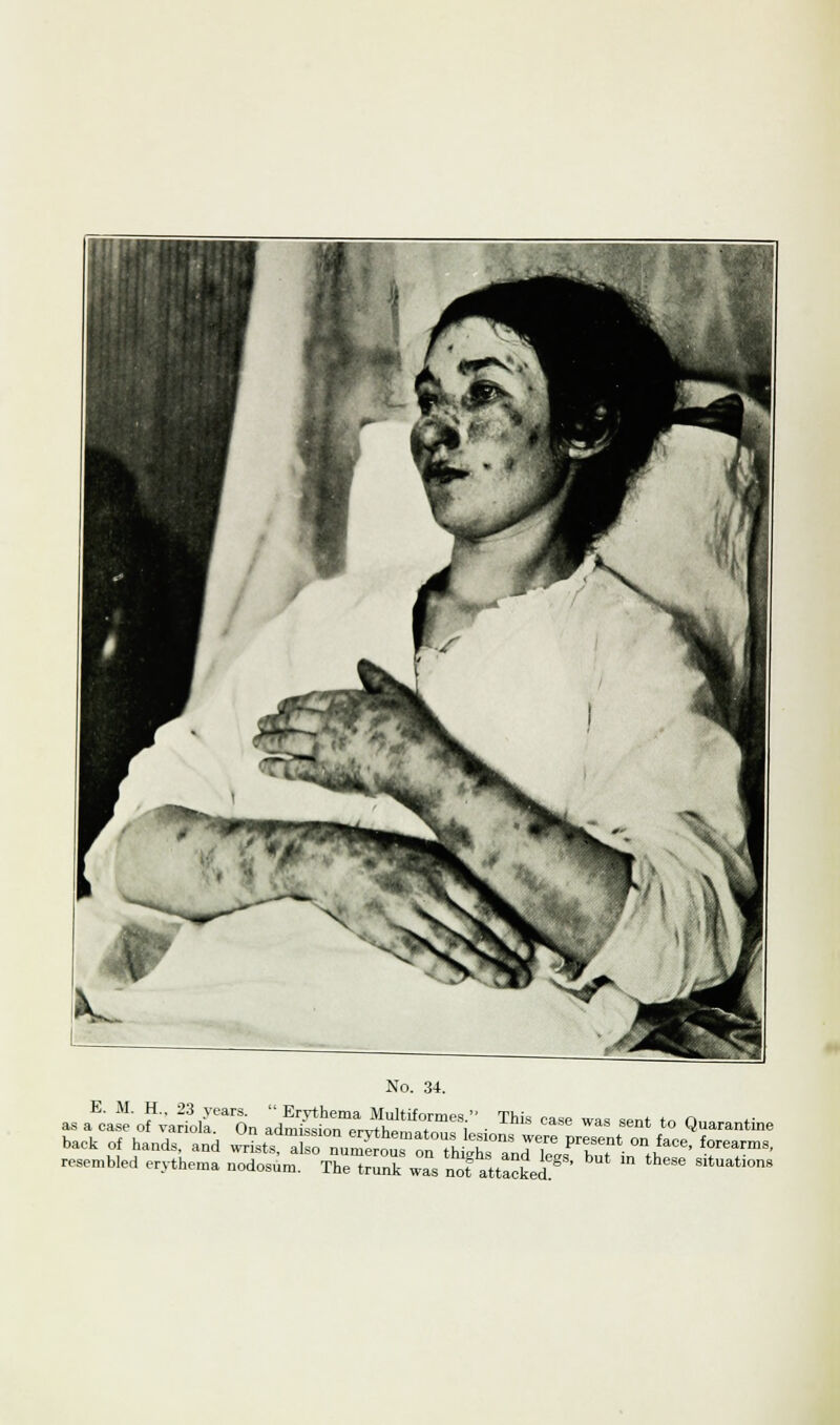 E. M. H„ 23 years. Erythema Multiformes.' as a case of variola. On admission ervth „ i T}S °aSG WaS Sent to Quarantine Ine trunk was not attacked. resembled erythema nodosum.
