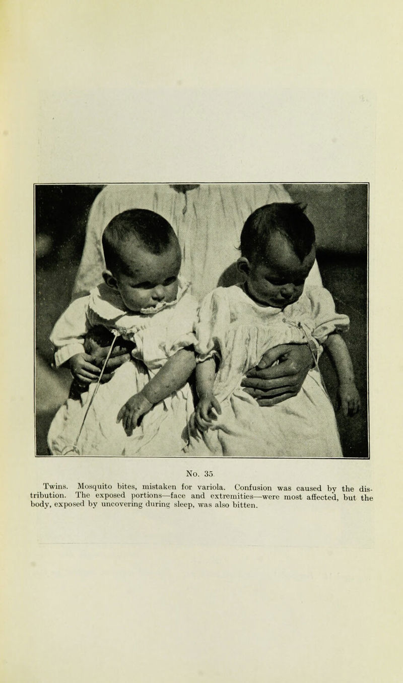 Twins. Mosquito bites, mistaken for variola. Confusion was caused by the dis- tribution. The exposed portions—face and extremities—were most affected, but the body, exposed by uncovering during sleep, was also bitten.