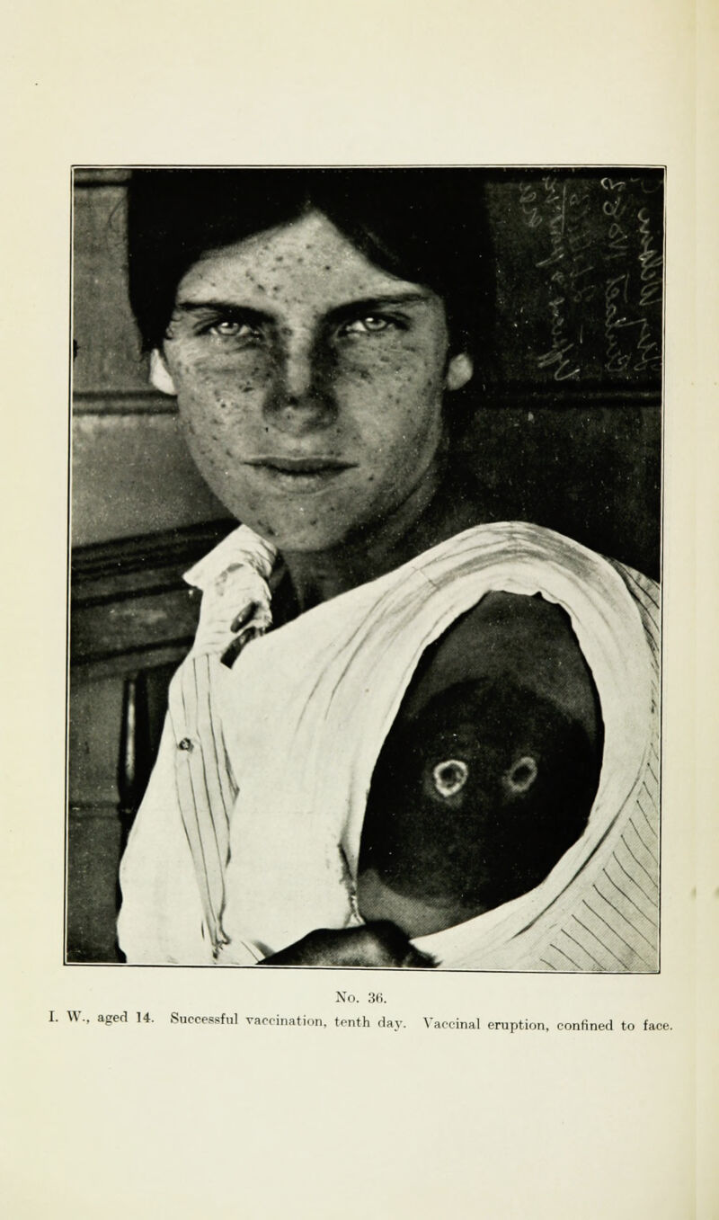 No. 3(i. I. W.. aged 14. Successful vaccination, tenth clay. Vaccinal eruption, confined to face.