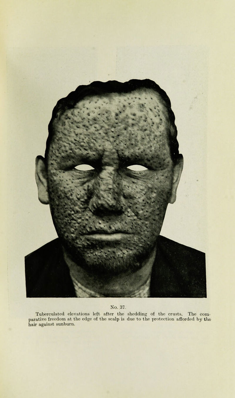 Tuberculated elevations left after the shedding of the crusts. The com- parative freedom at the edge of the scalp is due to the protection afforded by thfc hair against sunburn.