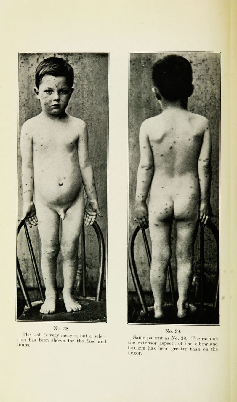 The rash ie very meagre, but .1 selec- tion has been shown for the face and limbs. No. 39. Same patient as No. 38. The rash on the extensor aspects of the elbow and forearm has been greater than on the flexor.