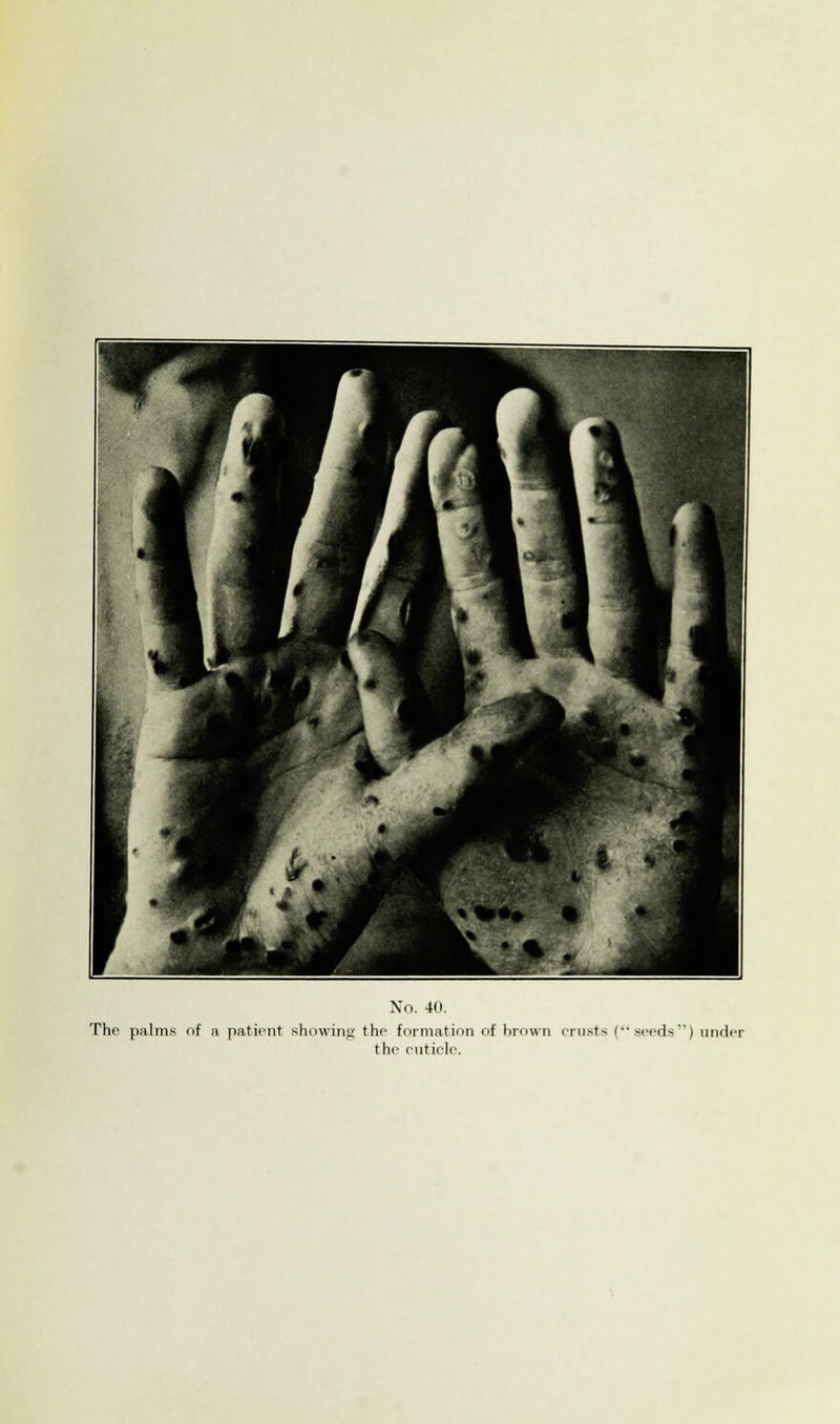 The palms of a patient showing the formation of brown crusts (seeds) under the cuticle.