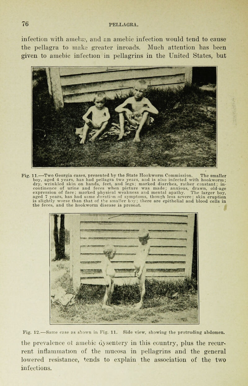 infection with amebsc, and an amebic infection would tend to cause the pellagra to make greater inroads. Much attention has been given to amebic infection in pellagrins in the United States, but Fig. 11.—-Two Georgia cases, presented by the State Hookworm Commission. The smaller boy, aged 4 years, has had pellagra two years, and is also infected with hookworm; dry, wrinkled skin on hands, feet, and legs; marked diarrhea, rather constant; in- continence of urine and feces when picture was made; anxious, drawn, old-age expression of face; marked physical weakness and mental apathy. The larger boy, aged 7 years, has had same duration of symptoms, though less severe; skin eruption is slightly worse than that of the smaller bny; there are epithelial and blood cells in the feces, and the hookworm disease is present. NJi ...■''.. X- Fig. 12.—Same case as shown in Fig. 11. Side view, showing the protruding abdomen, the prevalence ot amebic dysentery in tins country, plus the recur- rent inflammation of the mucosa in pellagrins and the general lowered resistance, tends to explain the association of the two infections.