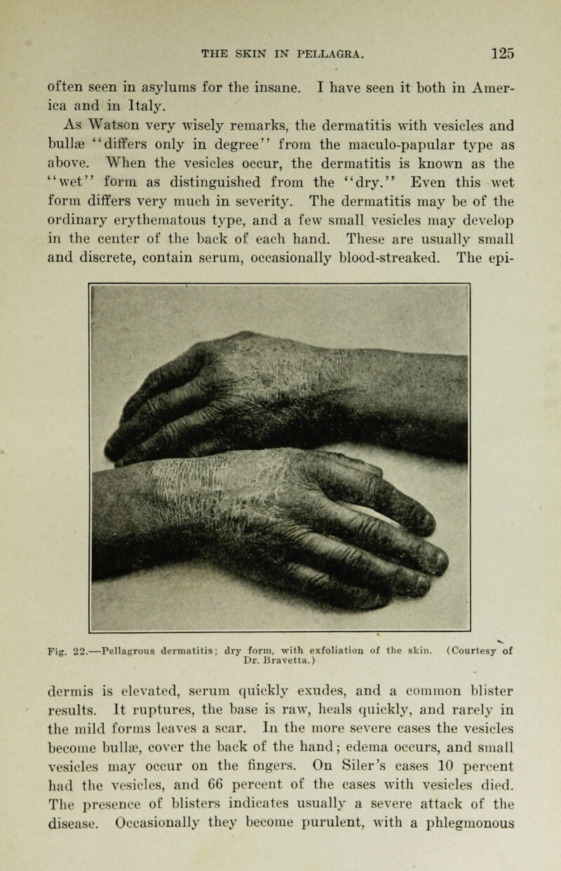 often seen in asylums for the insane. I have seen it both in Amer- ica and in Italy. As Watson very wisely remarks, the dermatitis with vesicles and bulla? differs only in degree from the maculo-papular type as above. When the vesicles occur, the dermatitis is known as the wet form as distinguished from the dry. Even this wet form differs very much in severity. The dermatitis may be of the ordinary erythematous type, and a few small vesicles may develop in the center of the back of each hand. These are usually small and discrete, contain serum, occasionally blood-streaked. The epi- Fig. 22.—Pellagrous dermatitis; dry form, with exfoliation of the skin. (Courtesy of Dr. Bravetta.) dermis is elevated, serum quickly exudes, and a common blister results. It ruptures, the base is raw, heals quickly, and rarely in the mild forms leaves a scar. In the more severe cases the vesicles become bullae, cover the back of the hand; edema occurs, and small vesicles may occur on the fingers. On Siler's cases 10 percent had the vesicles, and 66 percent of the cases with vesicles died. The presence of blisters indicates usually a severe attack of the disease. Occasionally they become purulent, with a phlegmonous