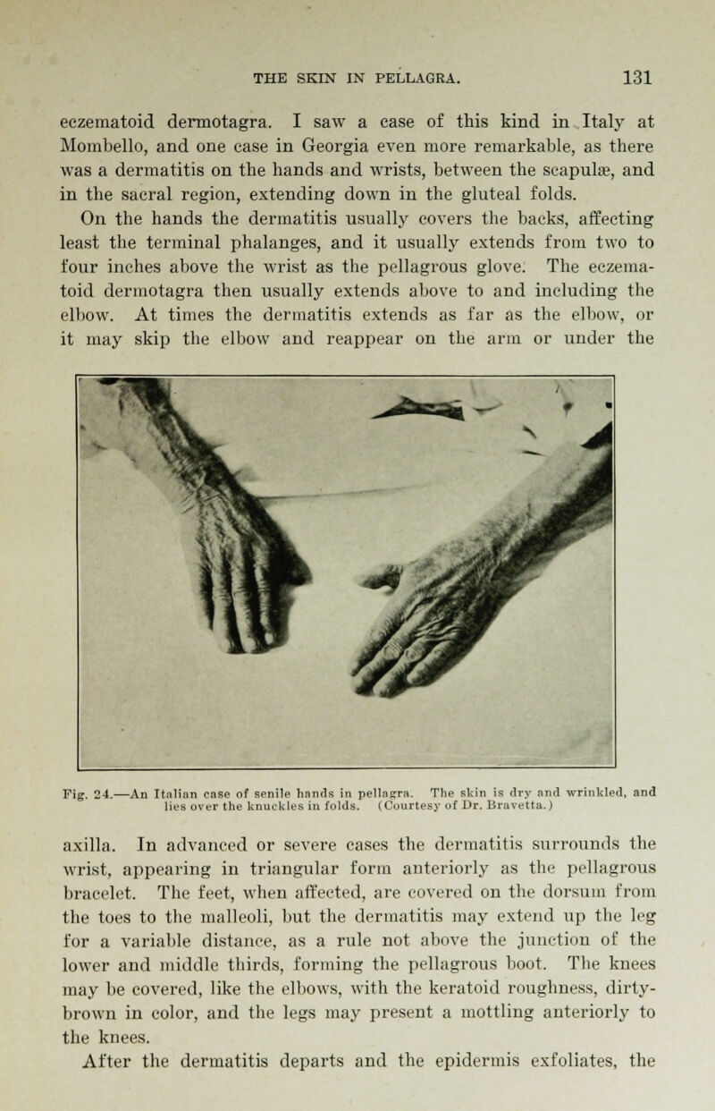 eczematoid dermotagra. I saw a case of this kind in Italy at Mombello, and one case in Georgia even more remarkable, as there was a dermatitis on the hands and wrists, between the scapula?, and in the sacral region, extending down in the gluteal folds. On the hands the dermatitis usually covers the backs, affecting least the terminal phalanges, and it usually extends from two to four inches above the wrist as the pellagrous glove. The eczema- toid dermotagra then usually extends above to and including the elbow. At times the dermatitis extends as far as the elbow, or it may skip the elbow and reappear on the arm or under the Fig. 24, -An Italian case of senile hands in pellagra. The skin is dry and wrinkled, and lies over the knuckles in folds. (Courtesy of Dr. Bravetta.) axilla. In advanced or severe cases the dermatitis surrounds the wrist, appearing in triangular form anteriorly as the pellagrous bracclet. The feet, when affected, are covered on the dorsum from the toes to the malleoli, but the dermatitis may extend up the leg for a variable distance, as a rule not above the junction of the lower and middle thirds, forming the pellagrous boot. The knees may be covered, like the elbows, with the keratoid roughness, dirty- brown in color, and the legs may present a mottling anteriorly to the knees. After the dermatitis departs and the epidermis exfoliates, the