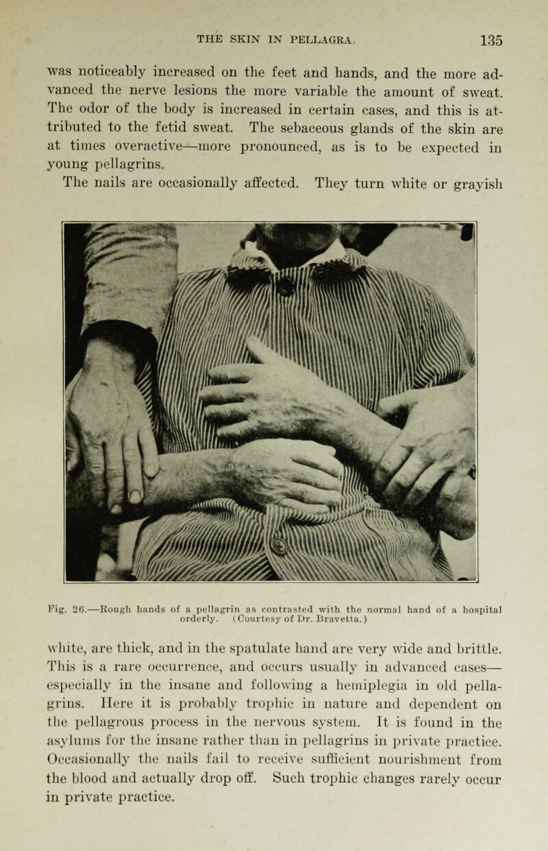 was noticeably increased on the feet and hands, and the more ad- vanced the nerve lesions the more variable the amount of sweat. The odor of the body is increased in certain cases, and this is at- tributed to the fetid sweat. The sebaceous glands of the skin are at times overactive—more pronounced, as is to be expected in young pellagrins. The nails are occasionally affected. They turn white or grayish Fig. 26.—Rough hands of a pellagrin as contrasted with the normal hand of a hospital orderly. (Courtesy of Dr. Bravetta.) white, are thick, and in the spatalate hand are very wide and brittle. This is a rare occurrence, and occurs usually in advanced cases— especially iu the insane and following a hemiplegia in old pella- grins. Here it is probably trophic in nature and dependent on the pellagrous process in the nervous system. It is found in the asylums for the insane rather than in pellagrins in private practice. Occasionally the nails fail to receive sufficient nourishment from the blood and actually drop off. Such trophic changes rarely occur in private practice.