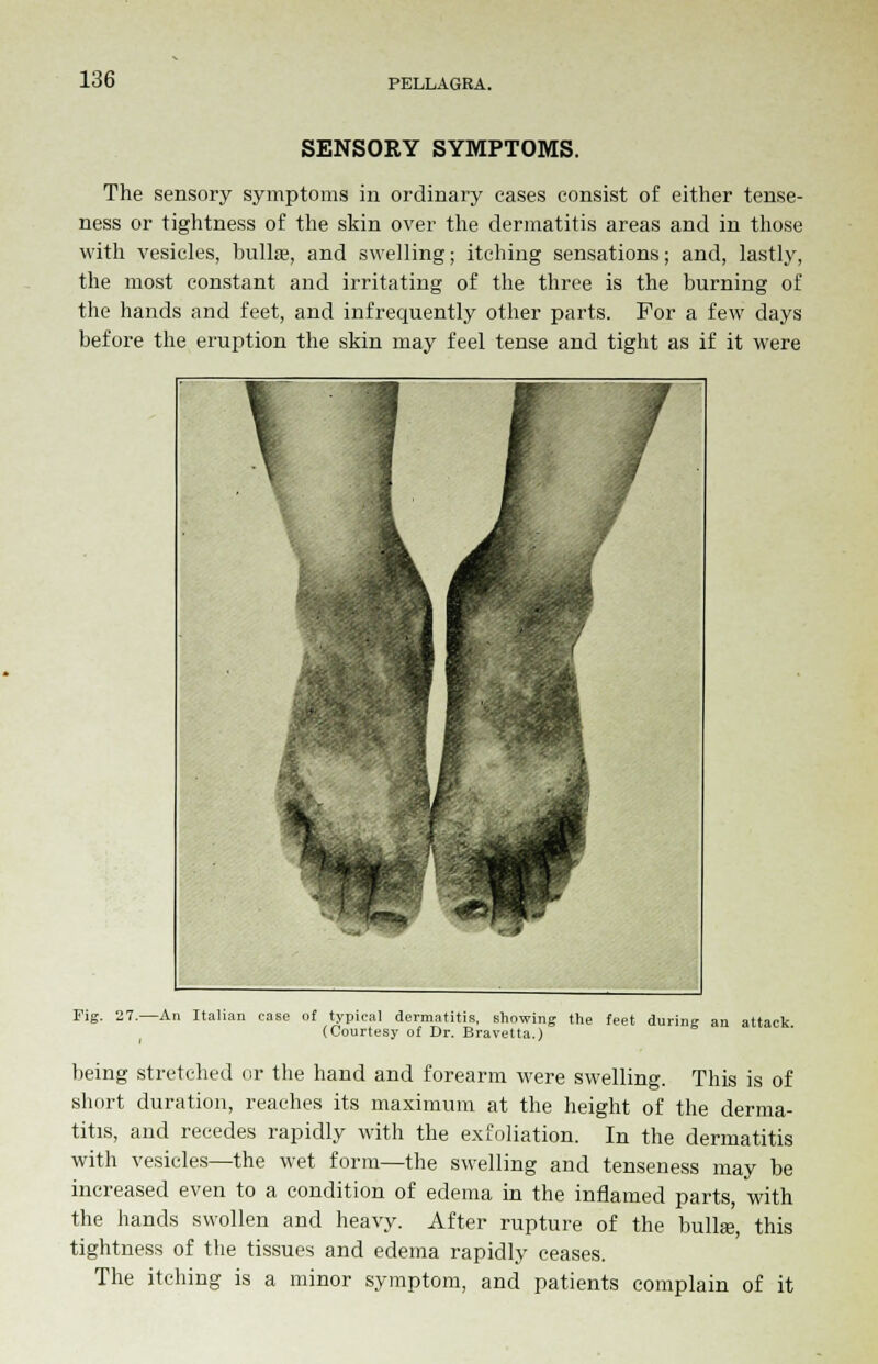 SENSORY SYMPTOMS. The sensory symptoms in ordinary cases consist of either tense- ness or tightness of the skin over the dermatitis areas and in those with vesicles, bullas, and swelling; itching sensations; and, lastly, the most constant and irritating of the three is the burning of the hands and feet, and infrequently other parts. For a few days before the eruption the skin may feel tense and tight as if it were Fig. 27.—An Italian case of typical dermatitis, showing the feet during an attack (Courtesy of Dr. Bravetta.) being stretched or the hand and forearm were swelling. This is of short duration, reaches its maximum at the height of the derma- titis, and recedes rapidly with the exfoliation. In the dermatitis with vesicles—the wet form—the swelling and tenseness may be increased even to a condition of edema in the inflamed parts, with the hands swollen and heavy. After rupture of the bulla;, this tightness of the tissues and edema rapidly ceases. The itching is a minor symptom, and patients complain of it