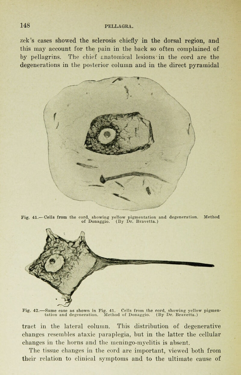 zek's cases showed the sclerosis chiefly in the dorsal region, and this may account for the pain in the back so often complained of by pellagrins. The chief anatomical lesions'in the cord are the degenerations in the posterior column and in the direct pyramidal ! * I M « Fig. 41.—Cells from the cord, showing yellow pigmentation and degeneration. Method of Donaggio. (By Dr. Bravetta.) Fig. 42.—Same case as shown in Fig. 41. Cells from the cord, showing yellow pigmen- tation and degeneration. Method of Donaggio. (By Dr. Bravetta.) tract in the lateral column. This distribution of degenerative changes resembles ataxic paraplegia, but in the latter the cellular changes in the horns and the meningo-myelitis is absent. The tissue changes in the cord are important, viewed both from their relation to clinical symptoms and to the ultimate cause of