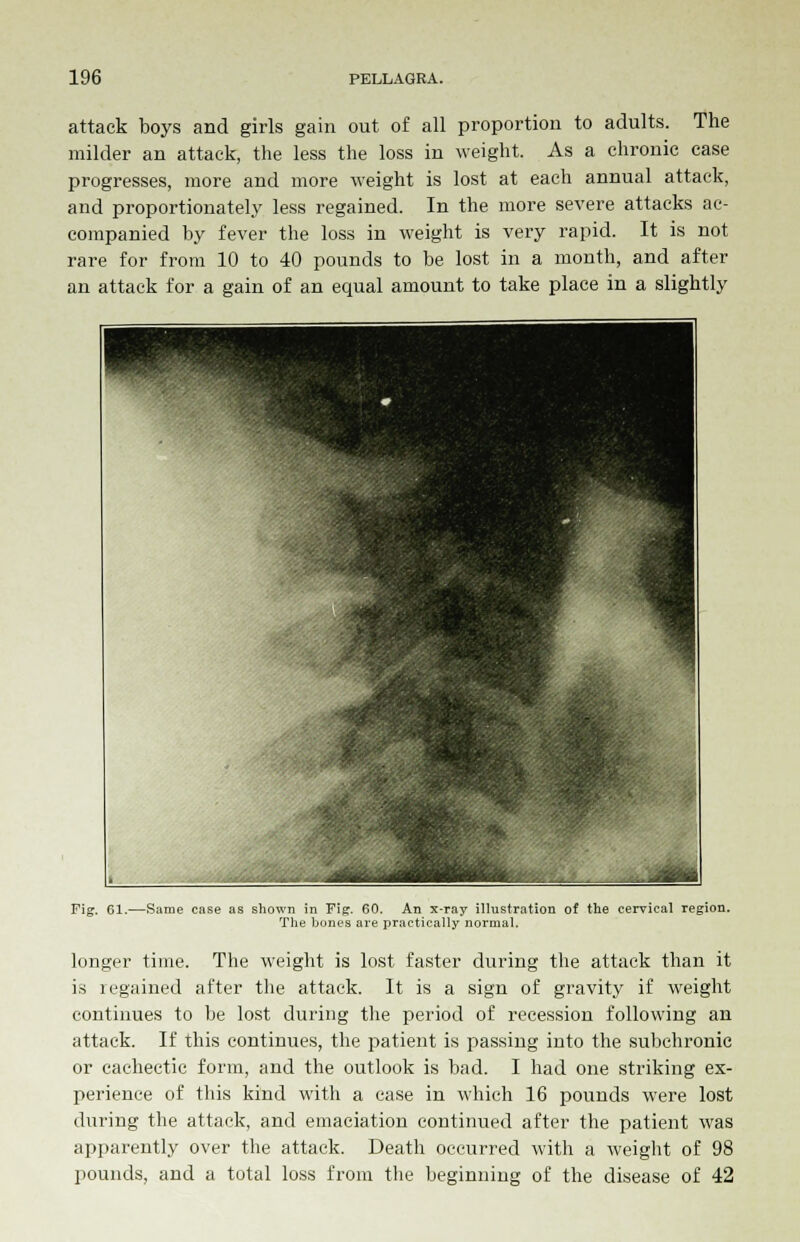 attack boys and girls gain out of all proportion to adults. The milder an attack, the less the loss in weight. As a chronic case progresses, more and more weight is lost at each annual attack, and proportionately less regained. In the more severe attacks ac- companied by fever the loss in weight is very rapid. It is not rare for from 10 to 40 pounds to be lost in a month, and after an attack for a gain of an equal amount to take place in a slightly Fig. 61.—Same case as shown in Fig. 60. An x-ray illustration of the cervical region. The bones are practically normal. longer time. The weight is lost faster during the attack than it is regained after the attack. It is a sign of gravity if weight continues to be lost during the period of recession following an attack. If this continues, the patient is passing into the subchronic or cachectic form, and the outlook is bad. I had one striking ex- perience of this kind with a case in which 16 pounds were lost during the attack, and emaciation continued after the patient was apparently over the attack. Death occurred with a weight of 98 pounds, and a total loss from the beginning of the disease of 42