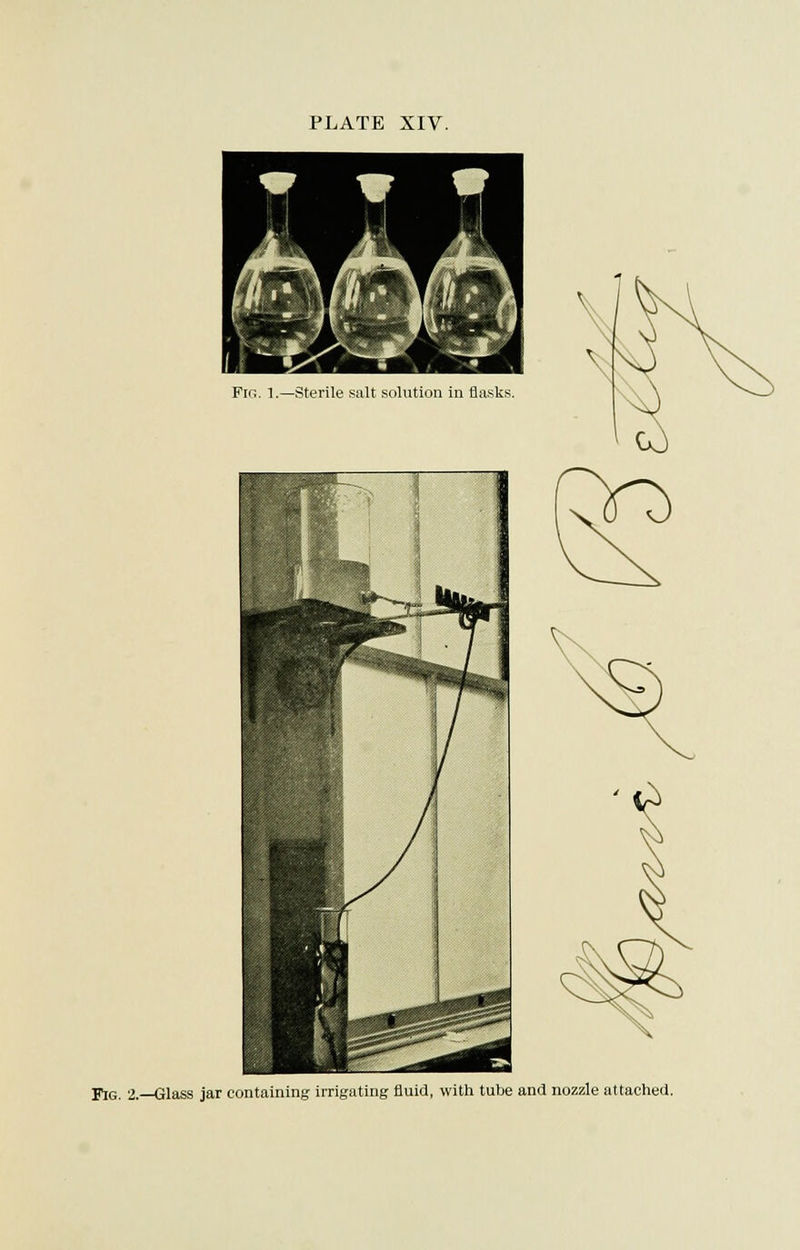 PLATE XIV. Fig. 2.—Glass jar containing irrigating fluid, with tube and nozzle attached.