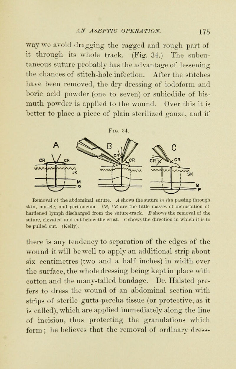 way we avoid dragging the ragged and rough part of it through its whole track. (Fig. 34.) The subcu- taneous suture probably has the advantage of lessening the chances of stitch-hole infection. After the stitches have been removed, the dry dressing of iodoform and boric acid powder (one to seven) or subibdide of bis- muth powder is applied to the wound. Over this it is better to place a piece of plain sterilized gauze, and if Fig 34. Removal of the abdominal suture. --1 shows the suture in situ passing through skin, muscle, and peritoneum. CR, CR are the little masses of incrustation of hardened lymph discharged from the suture-track. B shows the removal of the suture, elevated and cut below the crust. C shows the direction in which it is to be pulled out. (Kelly). there is any tendency to separation of the edges of the wound it will be well to apply an additional strip about six centimetres (two and a half inches) in width over the surface, the whole dressing being kept in place with cotton and the many-tailed bandage. Dr. Halsted pre- fers to dress the wound of an abdominal section with strips of sterile gutta-percha tissue (or protective, as it is called), which are applied immediately along the line of incision, thus protecting the granulations which form; he believes that the removal of ordinary dress-