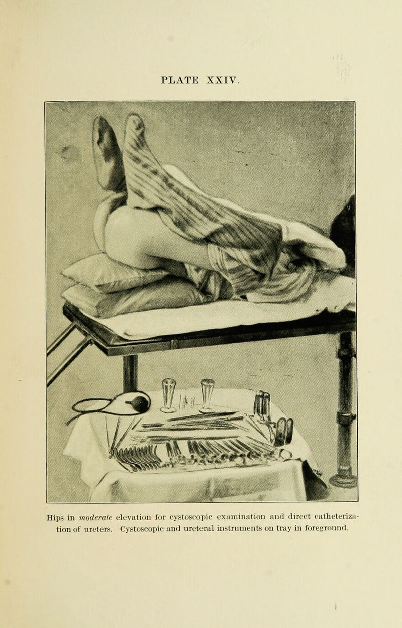 Hips in moderate elevation for cystoscopio examination and direct catheteriza- tion of ureters. Cystoseopic and ureteral instruments on tray in foreground.