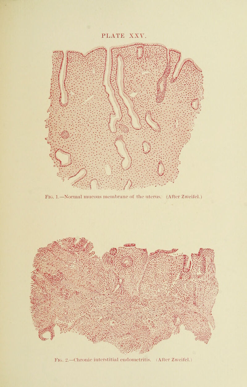 .■■•. •* ■ • , '/■.-•.•.:--. * 1|./A v: * J&l v;.--v^-:•::.;> V'.f-T: •• • \ :■../■::■% .t • X. , % \ • •? >:•..■•••--:• 5 ■• ••; ». • :■•.*••'•..• Fig. 1.—Normal mucous membrane of tin- uterus. (After Zweifel.) ^ w Fig. 2.—(Chronic interstitial endometritis i U'ter Zweifel.)