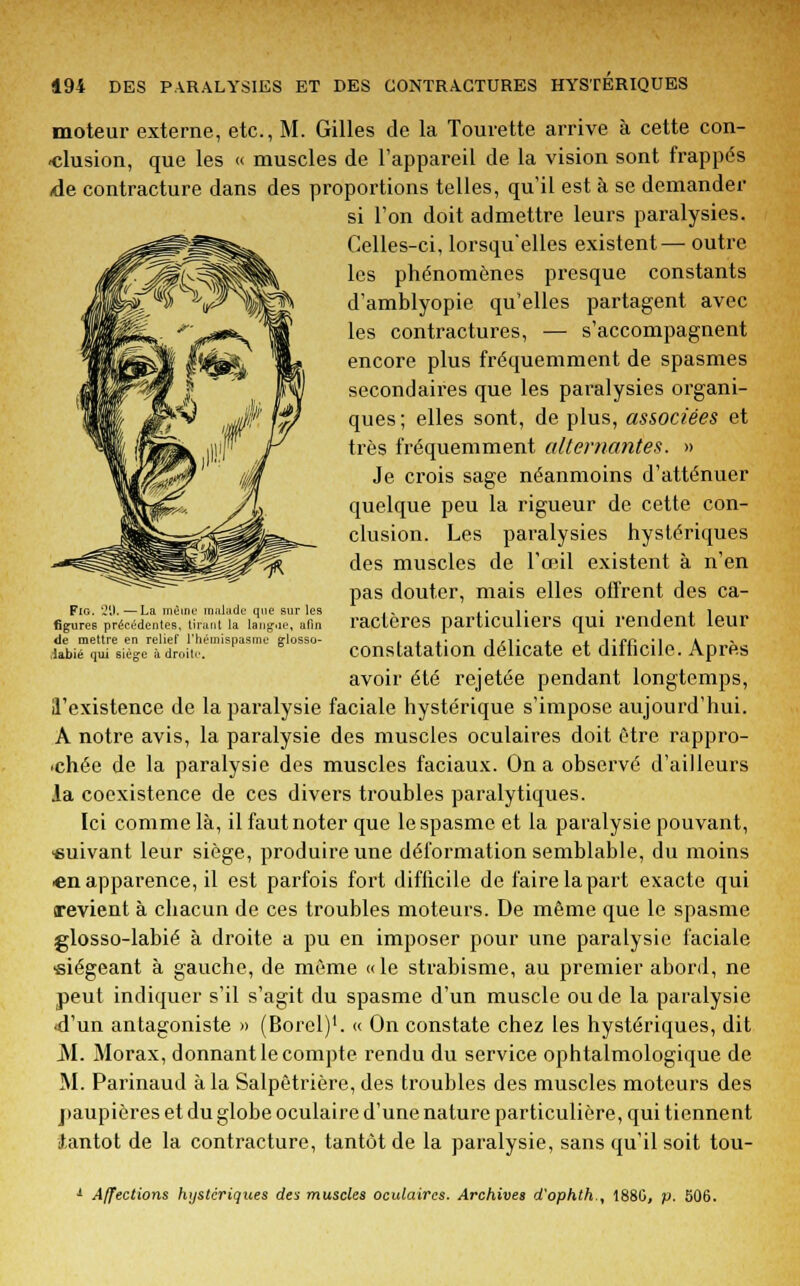 moteur externe, etc., M. Gilles de la Tourette arrive à cette con- clusion, que les « muscles de l'appareil de la vision sont frappés de contracture dans des proportions telles, qu'il est à se demander si l'on doit admettre leurs paralysies. Celles-ci, lorsqu'elles existent— outre les phénomènes presque constants d'amblyopie qu'elles partagent avec les contractures, — s'accompagnent encore plus fréquemment de spasmes secondaires que les paralysies organi- ques; elles sont, de plus, associées et très fréquemment alternantes. » Je crois sage néanmoins d'atténuer quelque peu la rigueur de cette con- clusion. Les paralysies hystériques des muscles de l'œil existent à n'en pas douter, mais elles offrent des ca- ractères particuliers qui rendent leur constatation délicate et difficile. Après avoir été rejetée pendant longtemps, ll'existence de la paralysie faciale hystérique s'impose aujourd'hui. A notre avis, la paralysie des muscles oculaires doit être rappro- chée de la paralysie des muscles faciaux. On a observé d'ailleurs la coexistence de ces divers troubles paralytiques. Ici comme là, il faut noter que le spasme et la paralysie pouvant, suivant leur siège, produire une déformation semblable, du moins en apparence, il est parfois fort difficile de faire la part exacte qui revient à chacun de ces troubles moteurs. De même que le spasme glosso-labié à droite a pu en imposer pour une paralysie faciale siégeant à gauche, de même «le strabisme, au premier abord, ne peut indiquer s'il s'agit du spasme d'un muscle ou de la paralysie •d'un antagoniste » (Borel)1. « On constate chez les hystériques, dit M. Morax, donnant le compte rendu du service ophtalmologique de M. Parinaud à la Salpêtrière, des troubles des muscles moteurs des paupières et du globe oculaire d'une nature particulière, qui tiennent (tantôt de la contracture, tantôt de la paralysie, sans qu'il soit tou- Fig. 2î).—La même malade que sur les figures précédentes, tirant la langue, afin de mettre en relief l'hémispasme glosso- ilabié qui siège à droite. Affections hystériques des muscles oculaires. Archives d'ophth., 1880, p. 506.